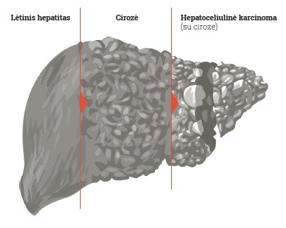 Hepatitas C